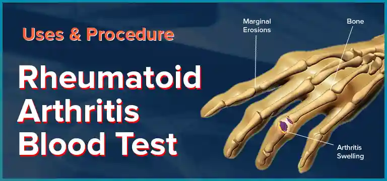 Rheumatoid Arthritis Blood Test - Uses, Procedure and Cost